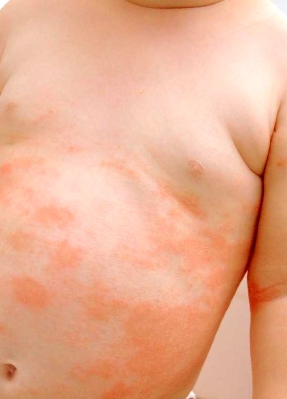 Как выглядит аллергия у детей: фото