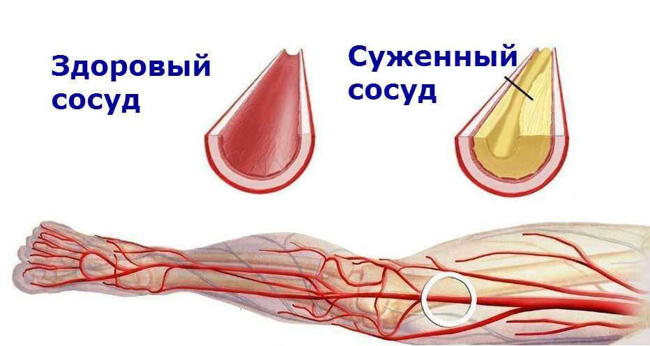 Как вылечить атеросклероз сосудов ног?: статьи клиники Оксфорд Медикал Киев